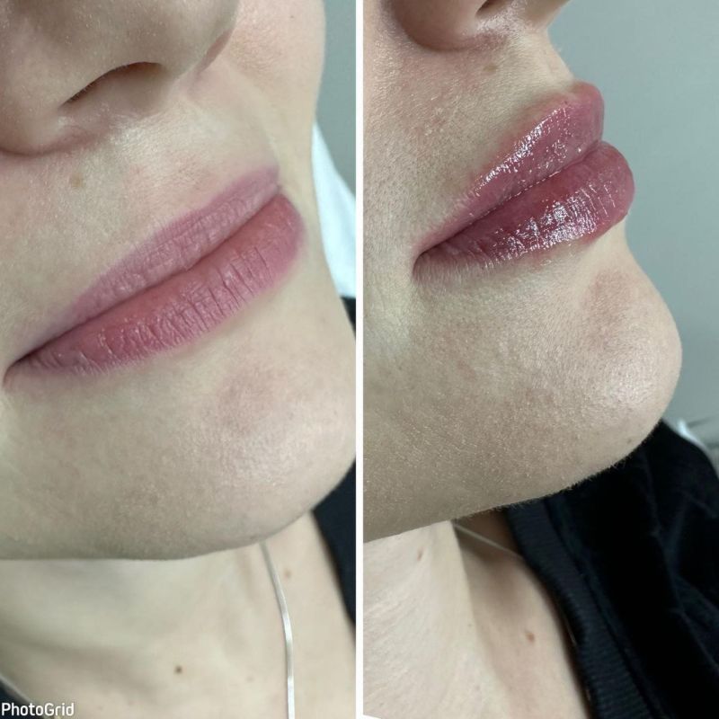 Глубокое увлажнение кожи и омоложение губ без изменения формы и объёма