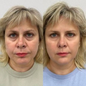 RF-лифтинг для лица!. Мощный аппарат нового поколения уже в работе — и даёт быстрые и заметные результаты Без боли, без уколов, без реабилитации