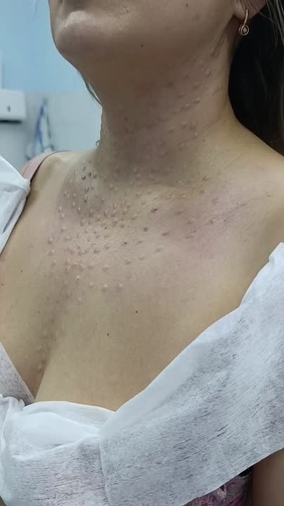 311111164. "Колье Картье" Омоложение кожи шеи и декольте коктейлем из аминокислот, трегалозы, цинка и гиалуроновой кислоты Курсом до 3 процедур и поддержка 8 Приём ведёт команда специалистов с медицинским образованием в...