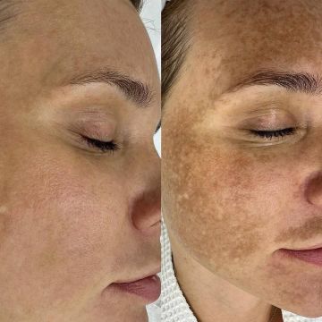 Пигментация -проблема, которая часто нас беспокоит, заставляет наносить тонны тонального крема и чувствовать себя неуверенными в себе Главные провокаторы пигментации : солнце, возраст, гормональные качели, агрессивные...