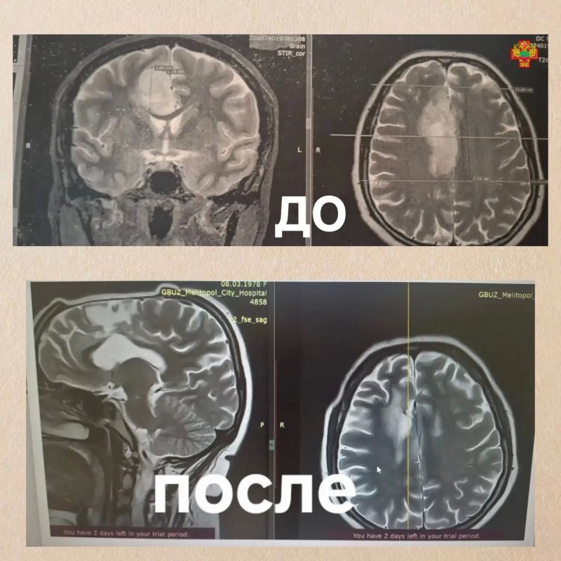 «Два года без рецидива»: как врачи спасли жительницу Запорожской области от астроцитомы